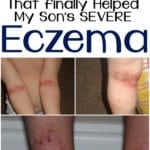 Goodbye Eczema!