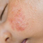 How Long Does Baby Acne Last?