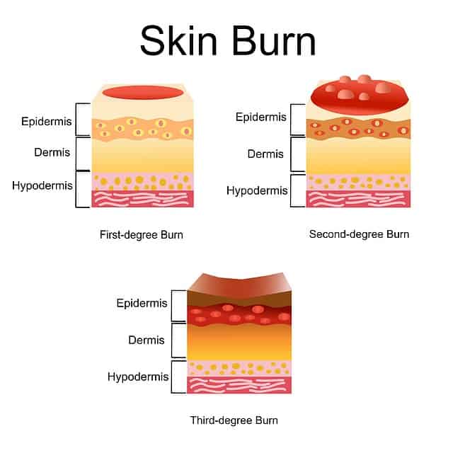 free-sunburn-severity-chart-check-your-health