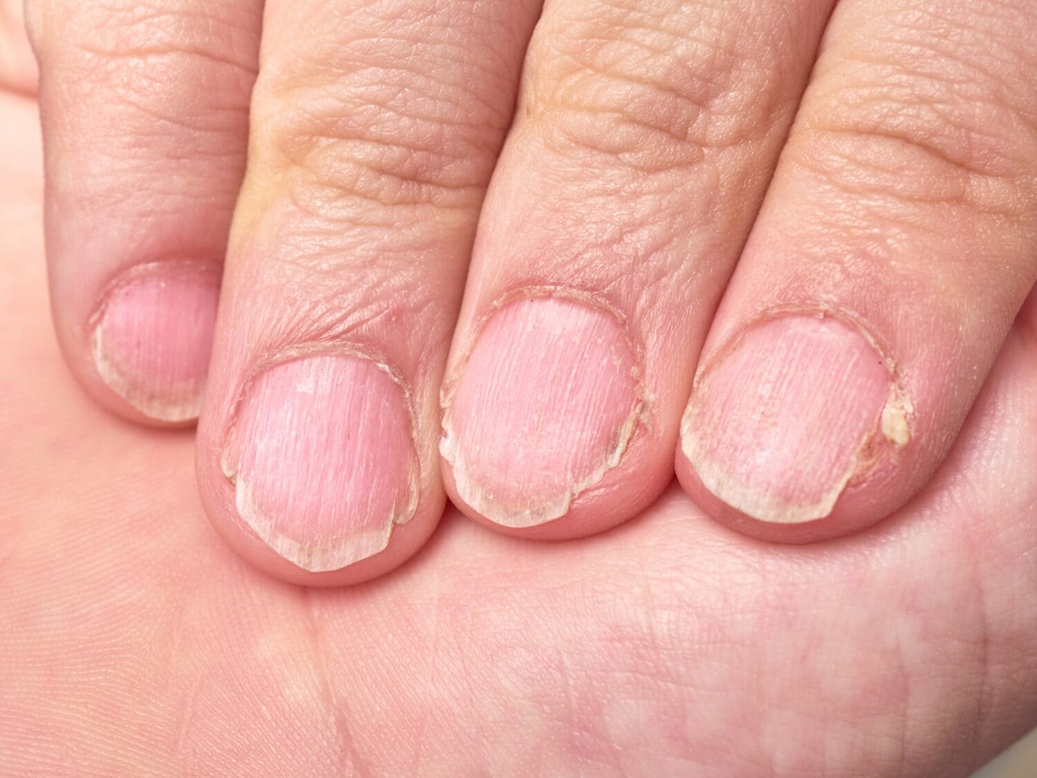 Nail Health Chart How To Identify Problems