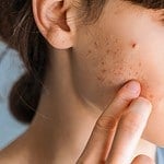 The 10 Best Home Remedies for Acne