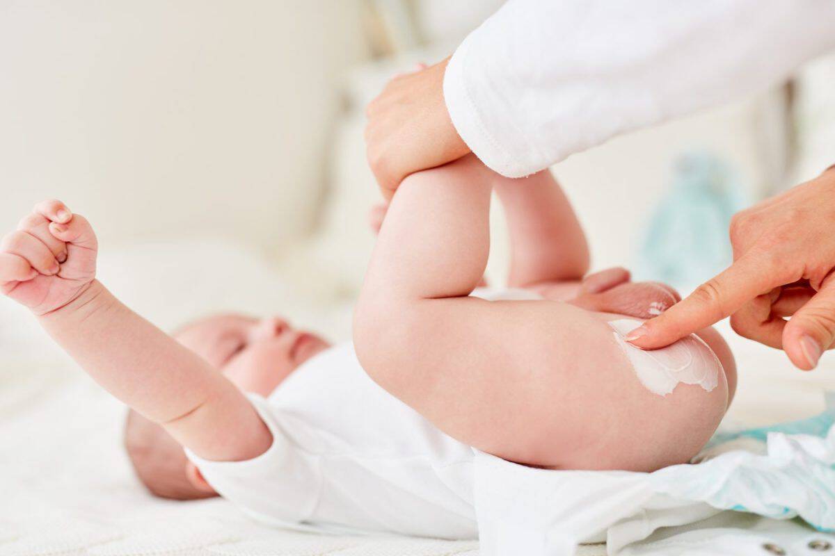 Mother creams the buttocks of an infant as a precaution against intertrigo. The best treatment options for diaper rash
