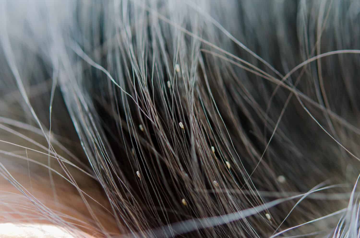 Lice eggs on the child's head cause head itching. Girls with long hair are more likely to develop lice than short hair.