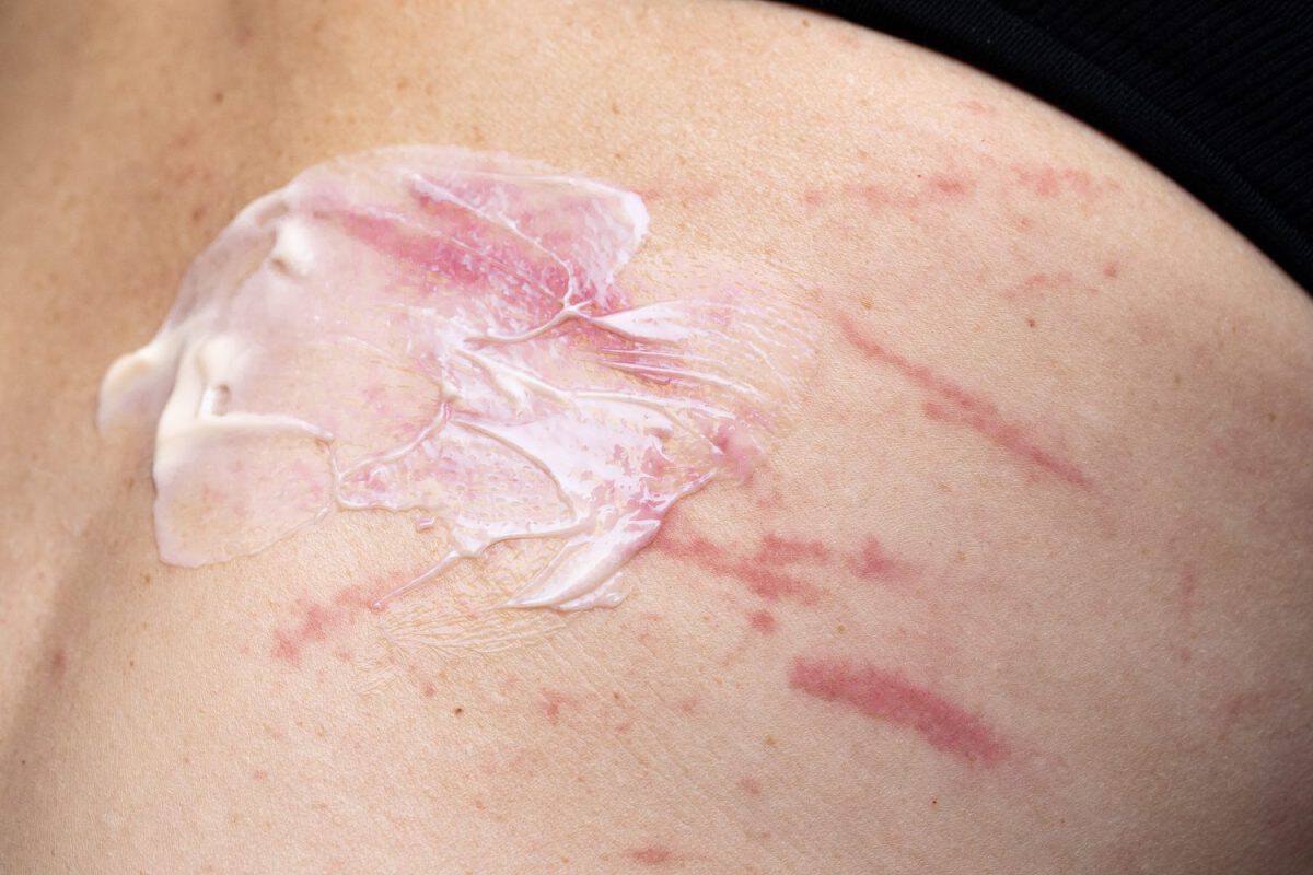 Cortisone cream spread on irritated skin. The best remedies for chigger bites.