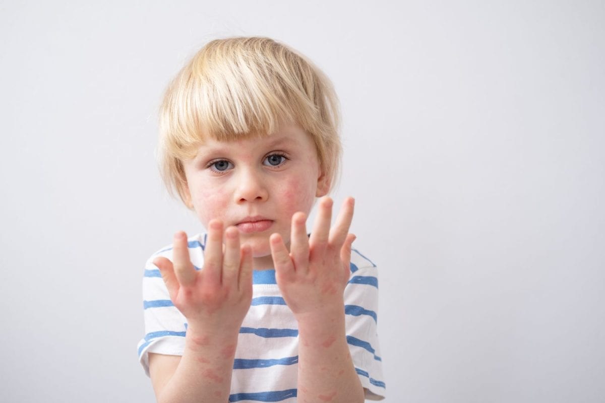 little boy with allergic rash or eczema on face and hands. severe allergic reaction, atopic skin. The Most Common Childhood Ailments and How to Treat Them