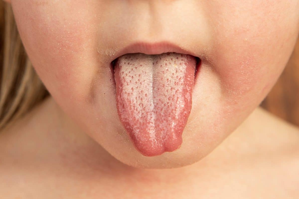 Strawberry tongue of a small child with scarlet fever caused by group A streptococcus