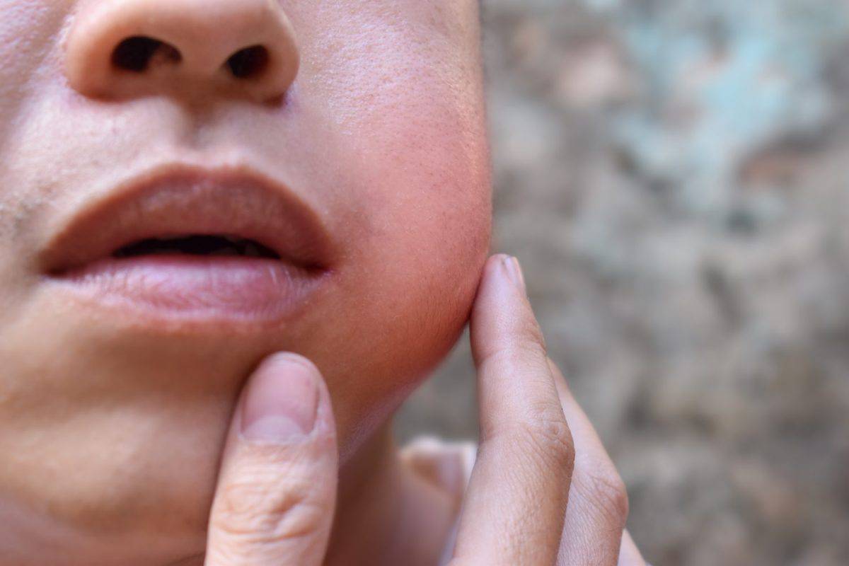 Swelling at the cheek of Asian young man. Inflammation of parotid gland called parotitis. Mumps.