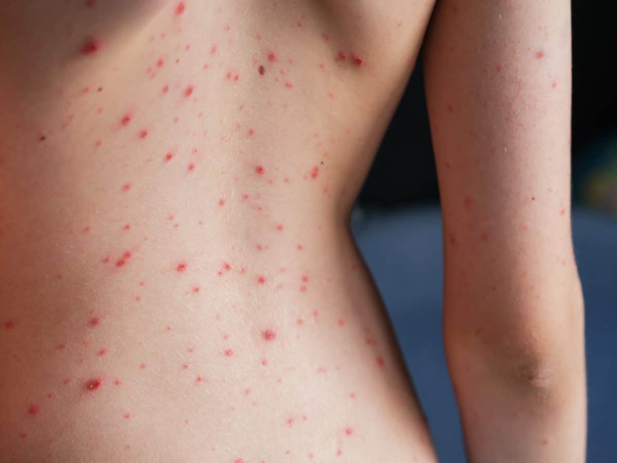 A person back with chickenpox (varicella) blisters on his skin.