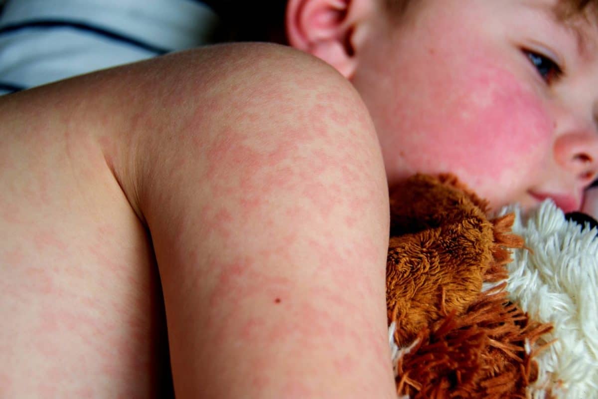 Viral disease. Measles rash on the body of the child. Allergy. A handsome boy with measles is sleeping in bed with his soft toy High quality photo