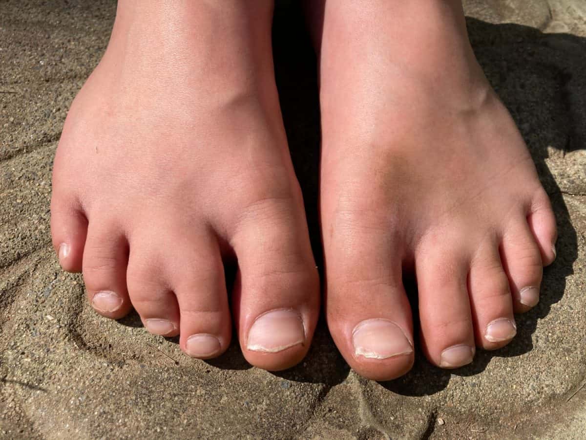 Barefoot young boy with webbed toe, syndactyly of the middle toes on right foot. Genetic congenital conditions and common birth abnormalities.