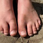 Y-Linked Disorders - Webbed Toes