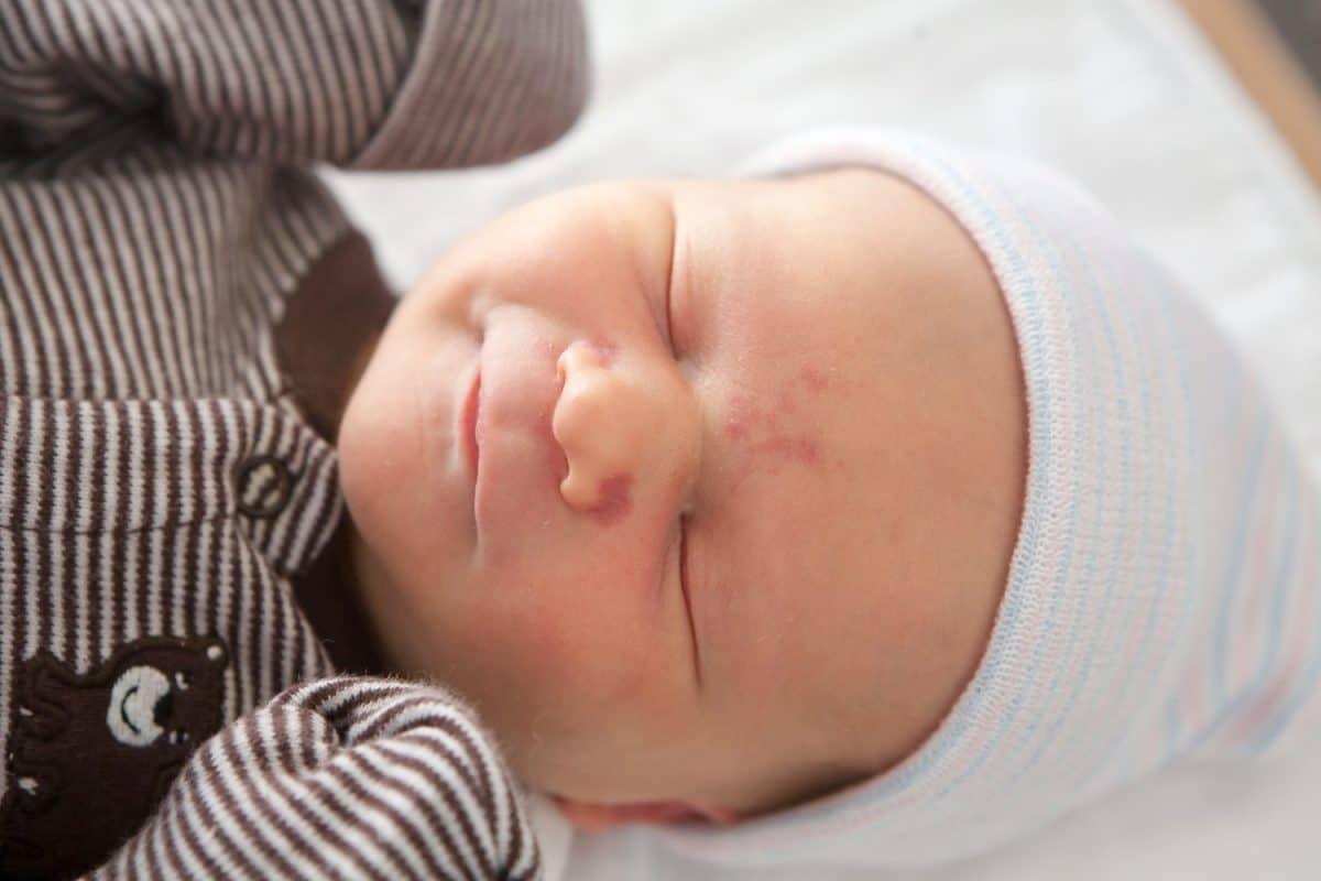 Newborn baby with a birthmark on his forehead smiling while asleep.